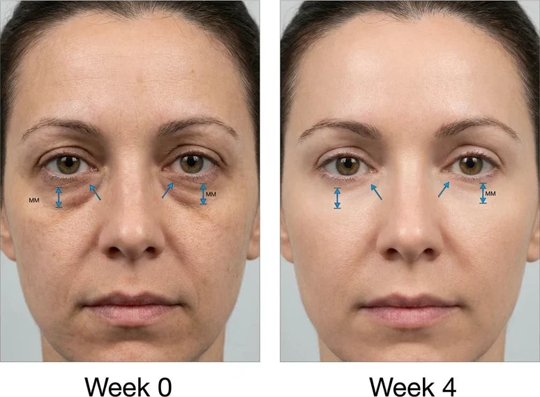 Under-eye comparison, Week 0 and Week 4