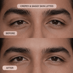 Micro - Infusion System For Upper Eyelids (Men) - Botanique Paris