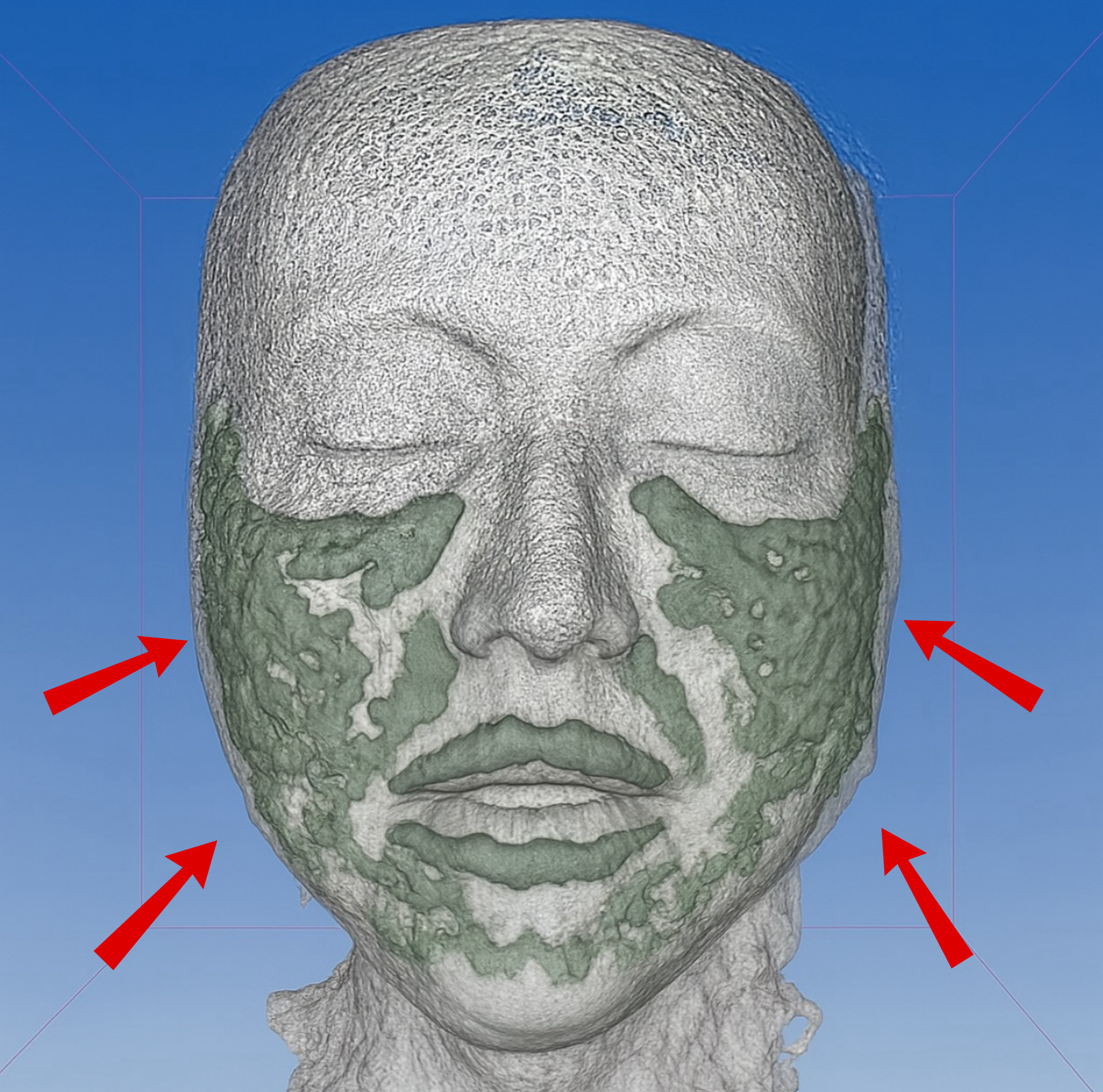3D model of a head with green patches on a blue background