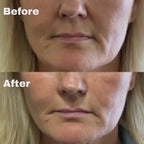 Micro-Infusion System For Smile Lines