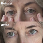 Micro-Infusion System For Under Eyes