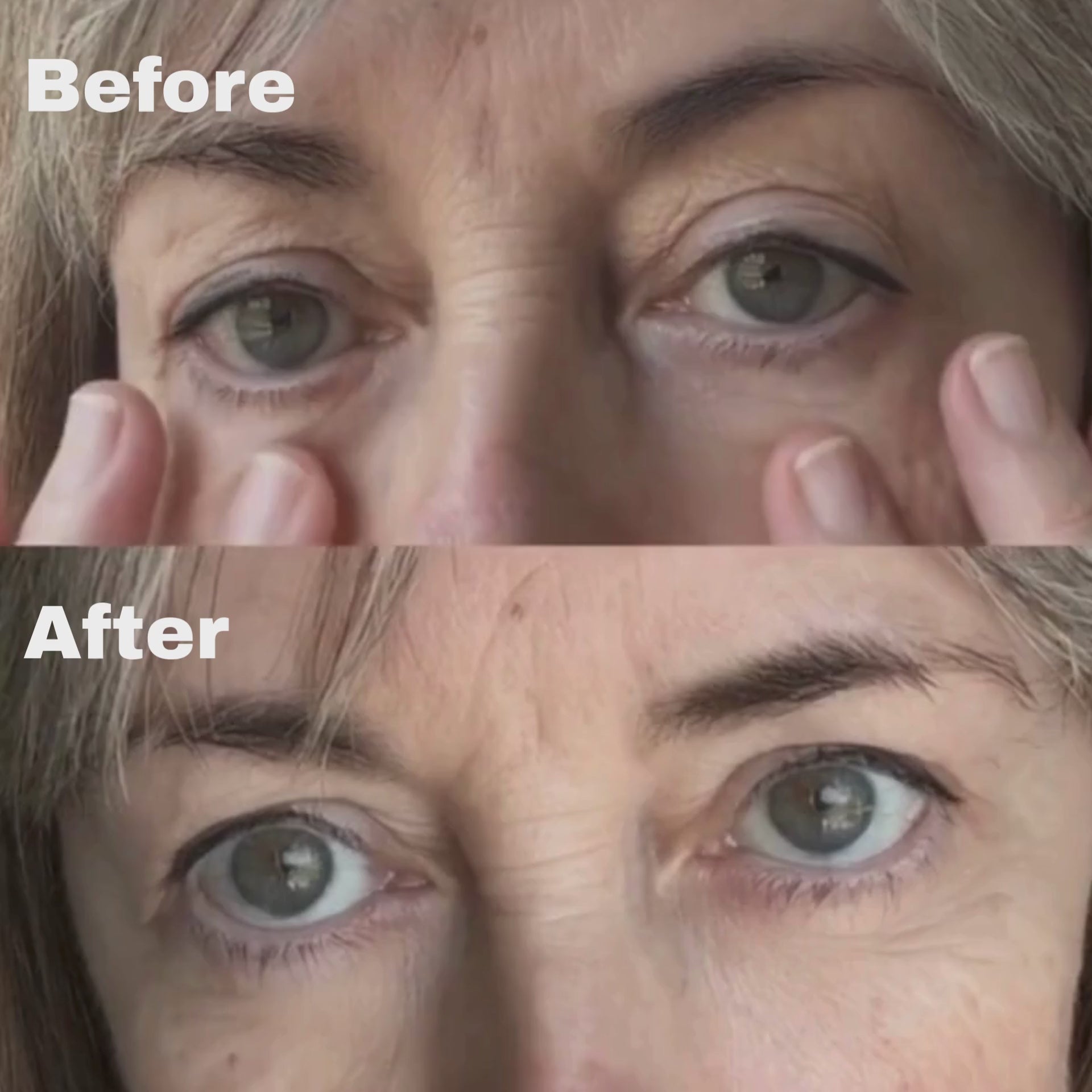 Micro-Infusion System For Under Eyes