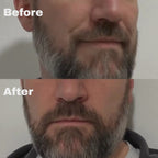 Micro-Infusion System For Smile Lines (Men)