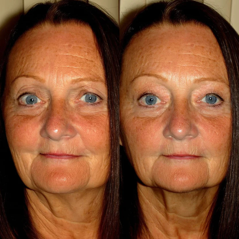 Before and after, hooded eyelids