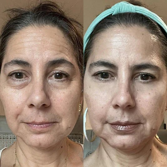 Inflamed, congested under-eyes before, and settled after