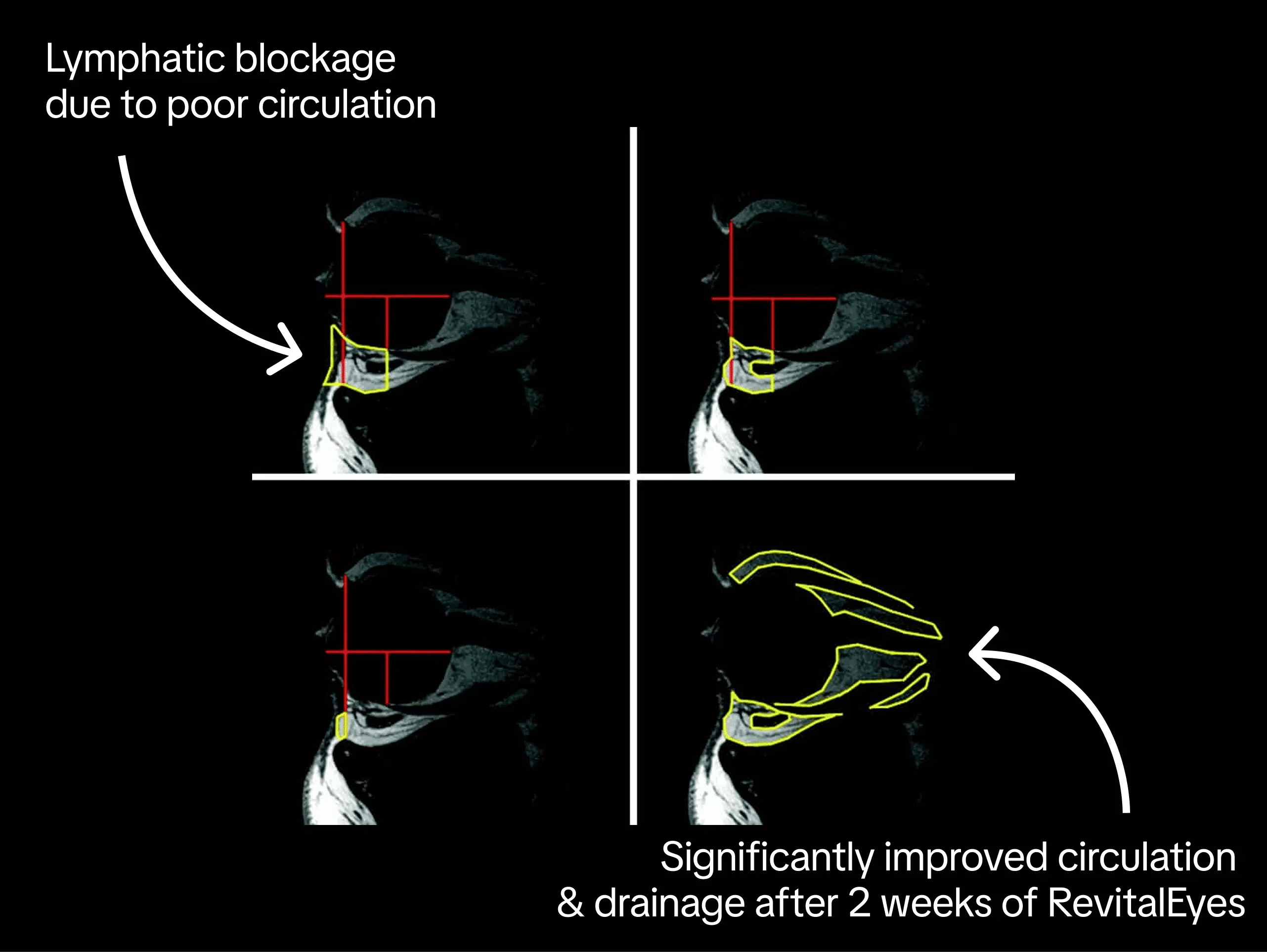 MRI scans showing lymphatic blockage and improved drainage after two weeks
